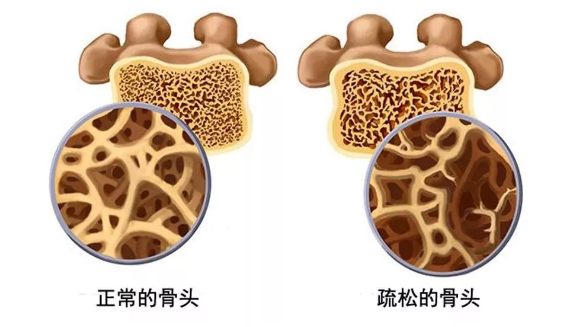 基于数字骨力学的精准医疗技术